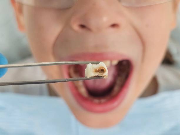 Best Emergency Treatment for Toothache in Pulaski, TN